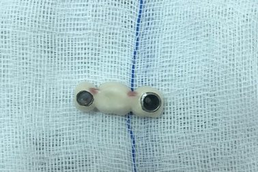 Người phụ nữ nuốt 4 chiếc răng giả khi ăn cơm