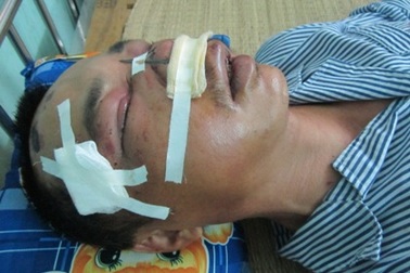 Đi ăn đêm vô cớ bị côn đồ bắt trả tiền, đánh vỡ xương mặt