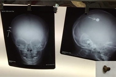 Cha mẹ bất cẩn, con bị đinh vít đâm sâu vào đầu