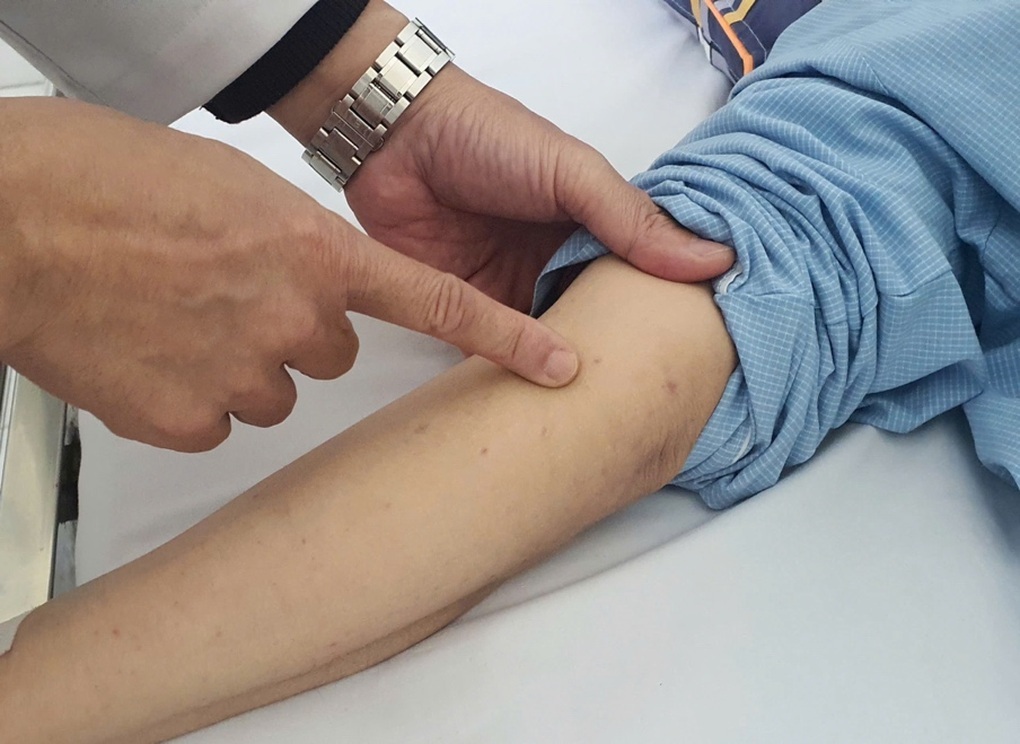 Tăng ca viêm màng não do não mô cầu, 82 người mắc trong 9 tháng - 1 Tăng ca viêm màng não do não mô cầu, 82 người mắc trong 9 tháng - 1