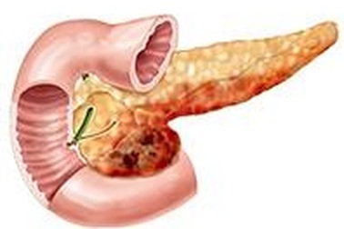 Bước tiến trong chẩn đoán và điều trị viêm tụy và ung thư tuyến tụy