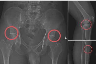 Tự đục vỡ xương để “qua mặt” bảo hiểm