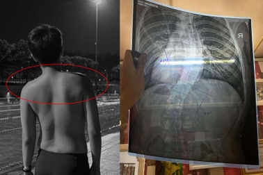 Dân văn phòng vai lệch nặng, cột sống cong vẹo trước tuổi 30