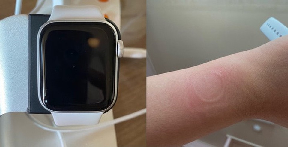 Đồng hồ “giá rẻ” Apple Watch SE khiến người dùng bị bỏng do quá tải nhiệt - 2 Đồng hồ “giá rẻ” Apple Watch SE khiến người dùng bị bỏng do quá tải nhiệt - 2