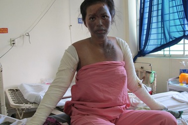 Một thai phụ bỏng nặng vì bếp gas mini