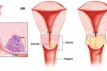 Những biến chứng nguy hiểm của ung thư cổ tử cung