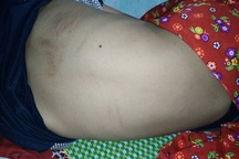 Bị mèo cào, bé trai 11 tuổi tử vong