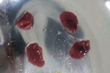 Tưởng mắc ung thư gan, đi khám mới biết do ký sinh trùng từ món quen thuộc