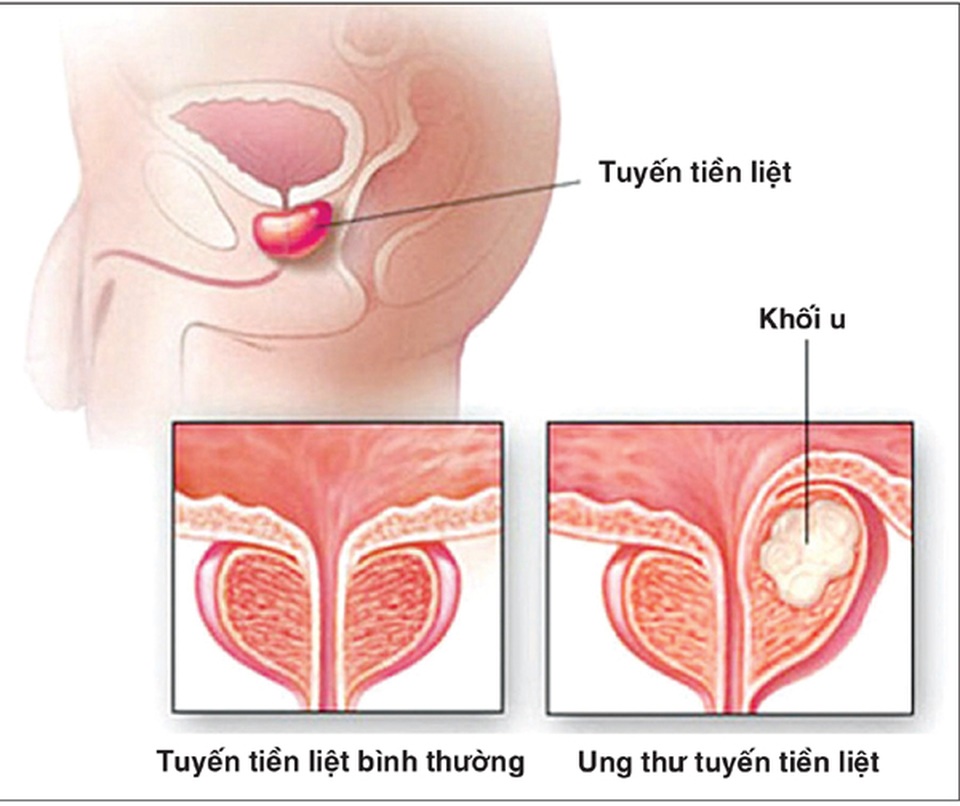 Ung thư tiền liệt tuyến có thễ chữa lành? - 1