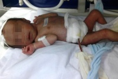 Cứu sống bé sơ sinh lòi gần nửa bộ ruột ra ngoài bụng