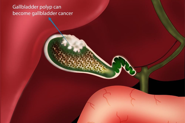 Polyp túi mật có phải là ung thư không?