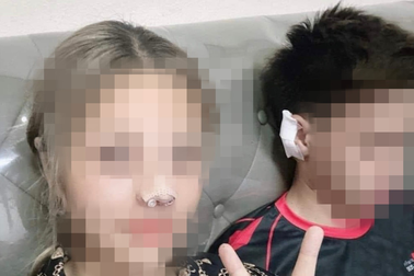 Bạn trai cho sụn tai để cô gái nâng mũi: Bác sĩ nói gì?