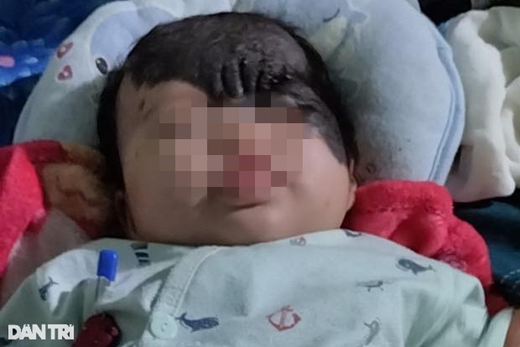 Mẹ phải điều trị tâm thần khi con gái vừa sinh đã mang gương mặt cháy đen - 2 Mẹ phải điều trị tâm thần khi con gái vừa sinh đã mang gương mặt cháy đen - 2