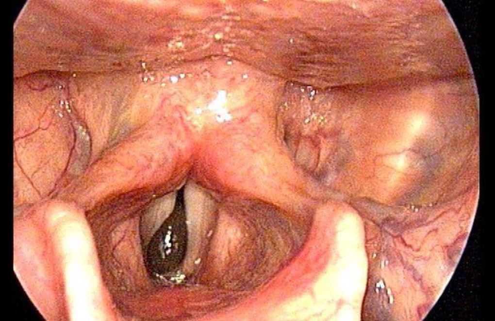 Dị vật sống bám chặt cổ họng người đàn ông suốt 2 tháng - 1 Dị vật sống bám chặt cổ họng người đàn ông suốt 2 tháng - 1