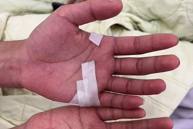 Ngứa "điên dại" khi nổi ban sốt xuất huyết phải làm sao?