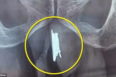 Kinh dị người đàn ông nhét 15 cây kim vào của quý