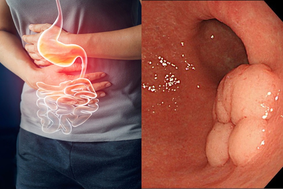 Đối phó với tình trạng giảm cân khi bị ung thư dạ dày - 1 Đối phó với tình trạng giảm cân khi bị ung thư dạ dày - 1