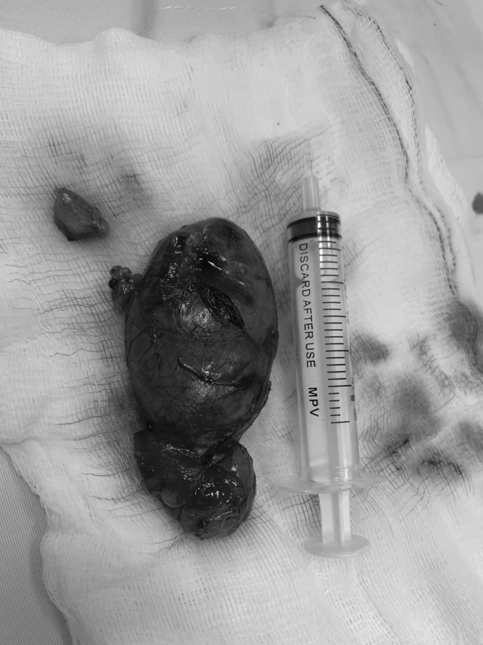 Quảng Nam: Phẫu thuật khối u lớn hiếm gặp ở vùng cổ bệnh nhân 13 tuổi - 2