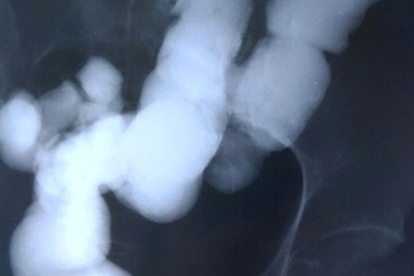 "Giải cứu" thành công ca táo bón suốt 20 năm