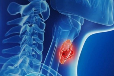 Ung thư tuyến giáp cần kiêng gì?