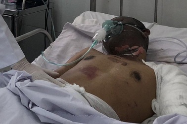 Vụ cháy 19 căn nhà: Tài xế xe bồn bỏng nặng, nguy kịch