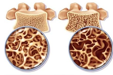 Khám phá giải pháp phòng ngừa loãng xương đơn giản