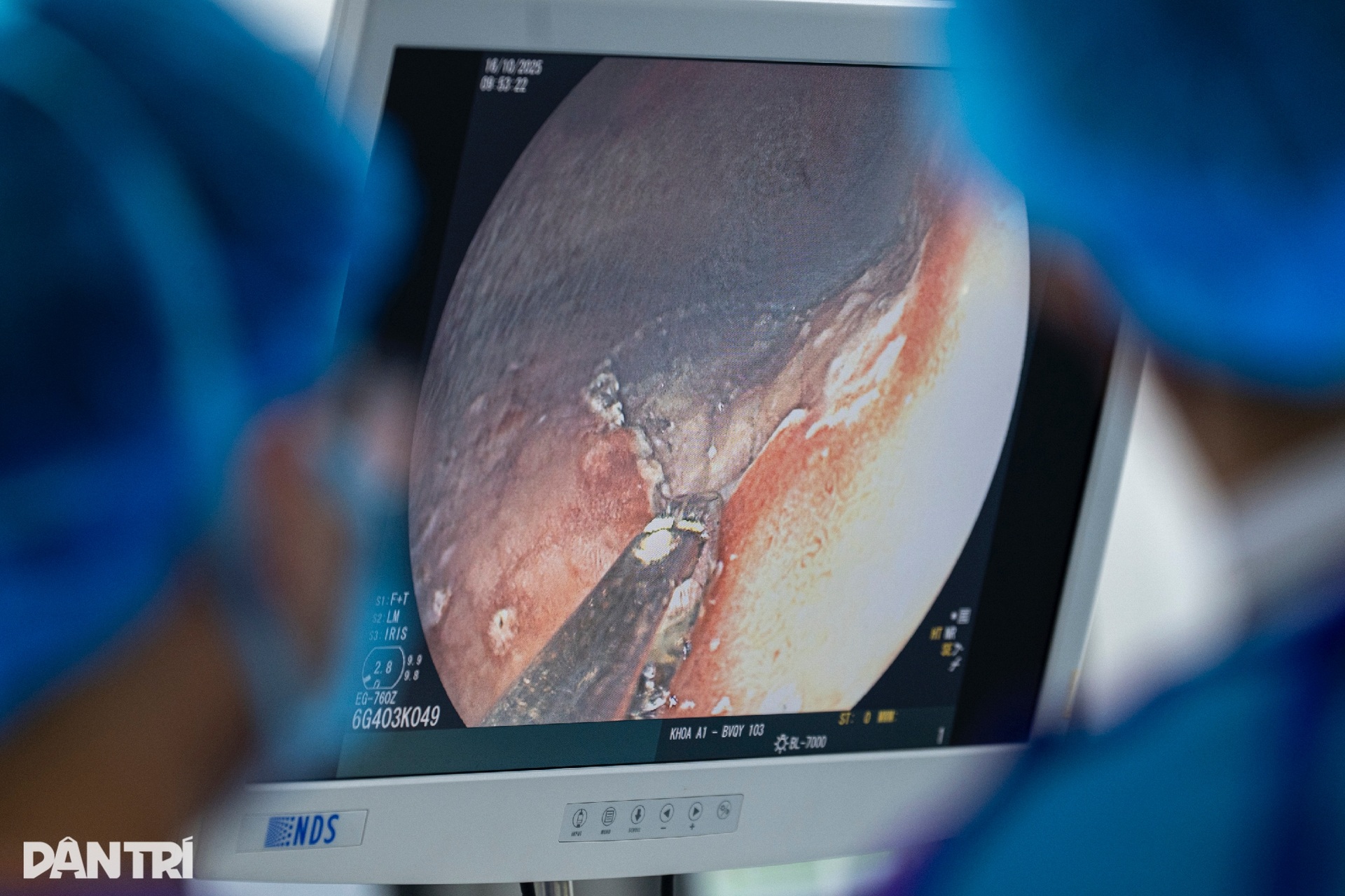 Xem bác sĩ thâm nhập dạ dày truy vết ung thư - 8 Xem bác sĩ thâm nhập dạ dày truy vết ung thư - 8