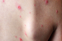 Người đầu tiên ở Đồng Nai bị đậu mùa khỉ