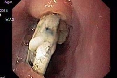 Mổ lấy cục pin nằm trong thực quản bé trai 2 tuổi