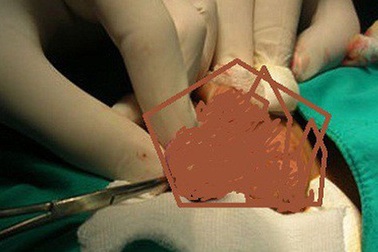 Hai bé trai bỗng bị hoại tử tinh hoàn