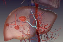 Dấu hiệu cảnh báo u máu trong gan