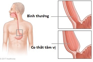 Những điều bạn cần biết để không lo lắng về ung thư thực quản