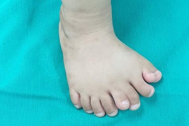 Thanh Hoá: Cậu bé có 9 ngón chân trên một bàn chân