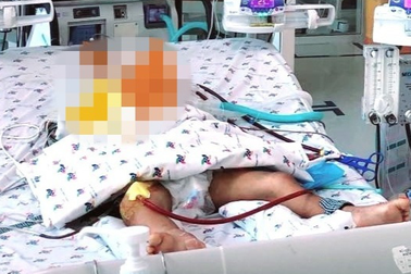 Bị ong vò vẽ trước nhà đốt 15 mũi, bé trai ở TPHCM tổn thương tim nguy kịch