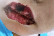 TPHCM: Bé trai 4 tuổi lở môi, dị ứng nặng sau uống thuốc ở phòng khám