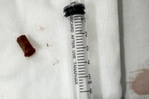 Bé trai bị lọt chiếc còi vào phổi suốt 7 năm