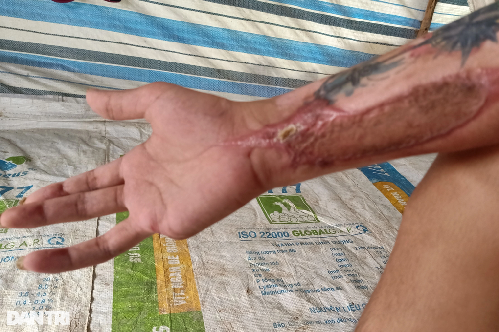 Bị tai nạn, chàng trai hiếu thảo mong có tiền lắp tay giả, phụ mẹ nuôi em - 3 Bị tai nạn, chàng trai hiếu thảo mong có tiền lắp tay giả, phụ mẹ nuôi em - 3
