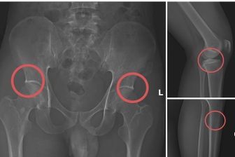 Tự đục vỡ xương để “qua mặt” bảo hiểm