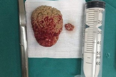 Bệnh nhân có sỏi thận to bằng quả trứng