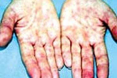 Chính thức công bố dịch bệnh “chân, tay, miệng”