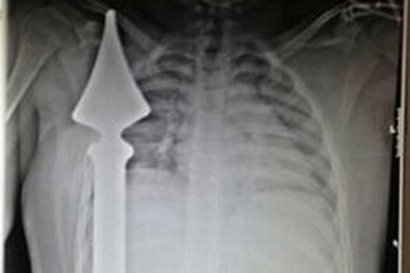 Thoát chết thần kỳ khi bị cọc sắt đâm gần tim