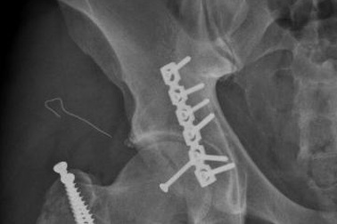 Phẫu thuật thành công cho phi công Canada gãy trật khớp háng nặng
