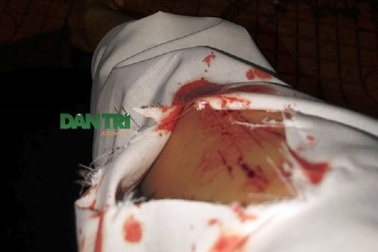 Cần làm gì khi bị kim dính máu nghi nhiễm HIV đâm?