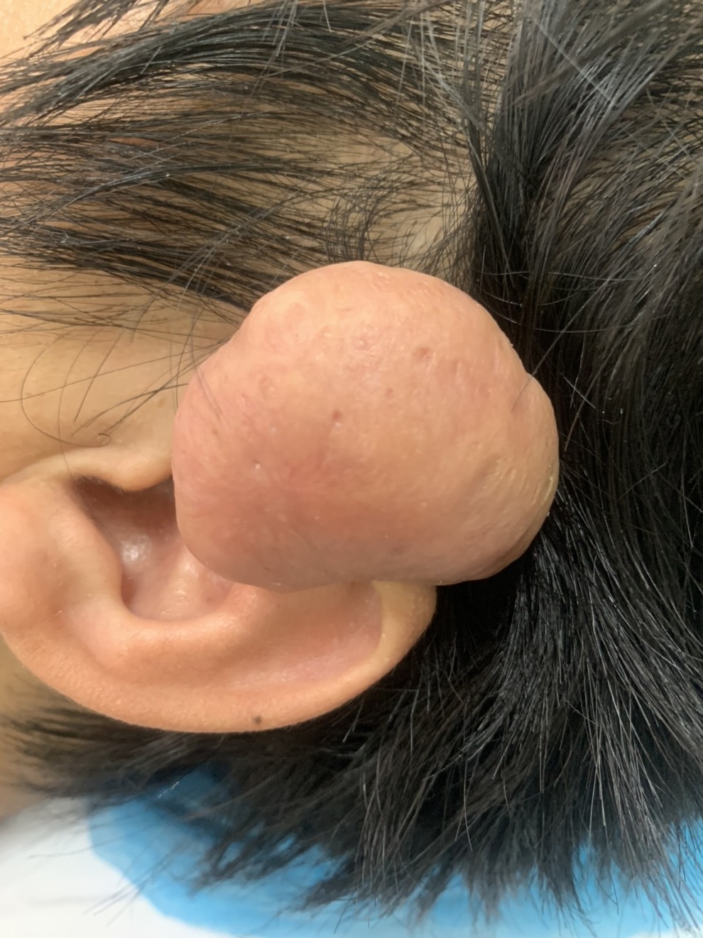 Phẫu thuật thành công khối u sụn cứng như đá hiếm gặp ở vành tai - 1