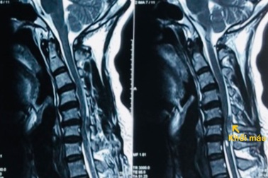 Đột ngột liệt tứ chi vì xuất huyết tủy sống cổ