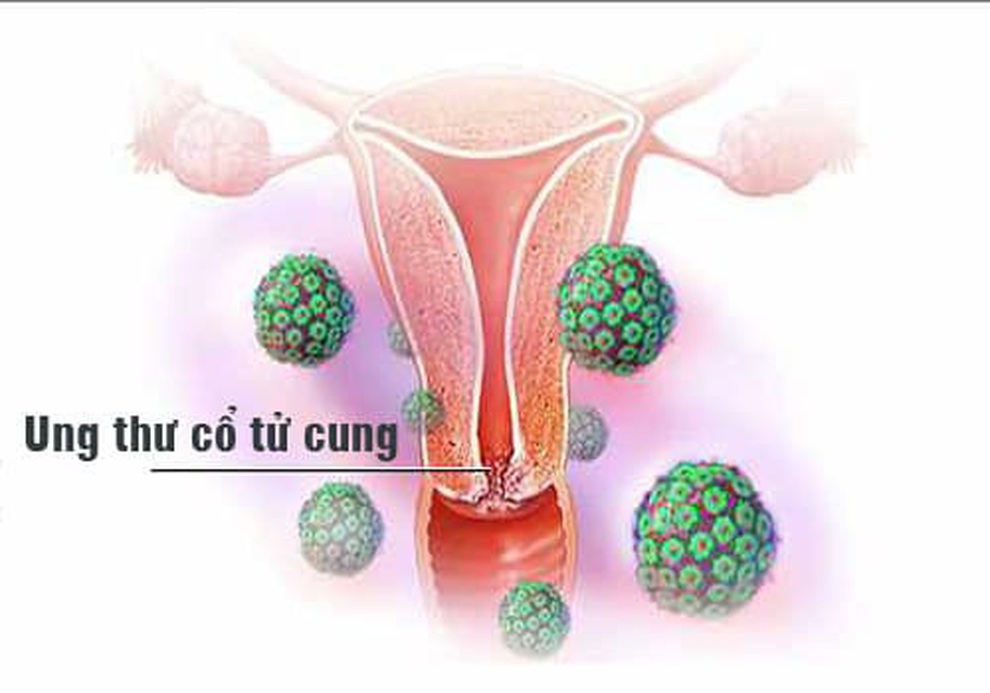 Các loại ung thư cổ tử cung - 1 Các loại ung thư cổ tử cung - 1