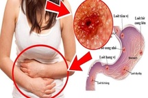 Ai có nguy cơ mắc ung thư dạ dày?