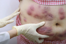 Thẩm mỹ viện ở TPHCM tiêm hủy mỡ làm nát bụng người phụ nữ rồi... biến mất