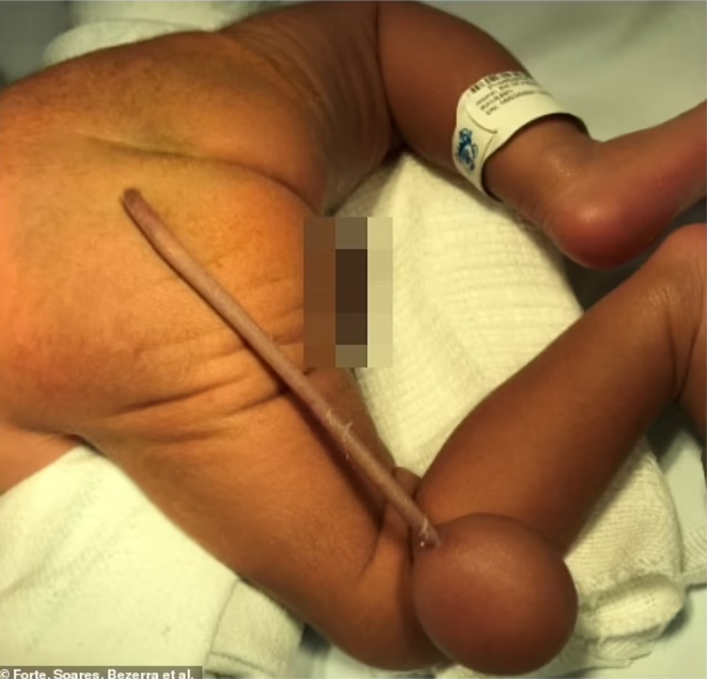 Cậu bé sinh ra với chiếc đuôi dài 12 cm - 1 Cậu bé sinh ra với chiếc đuôi dài 12 cm - 1