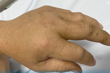 Truyền 18 lọ huyết thanh cứu bệnh nhân bị rắn lục đuôi đỏ cắn